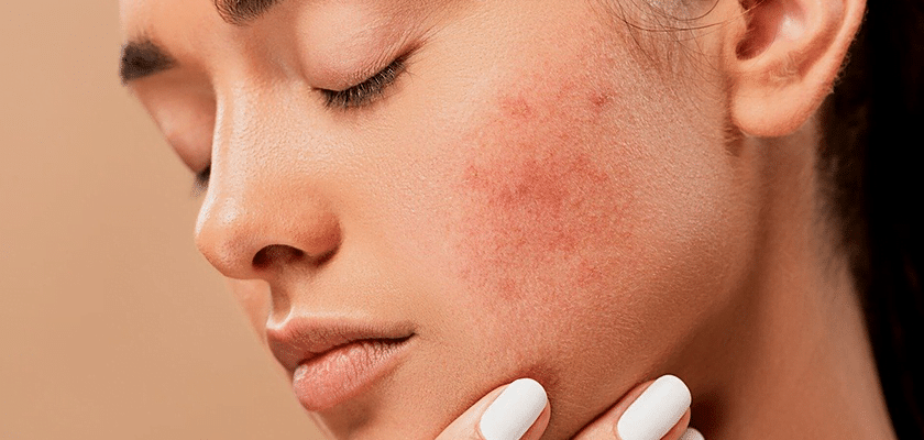 Acne Scar Treatment in Turkey