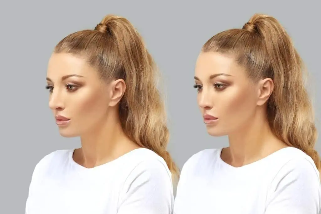 After Rhinoplasty Surgery 21 Preservation Rhinoplasty