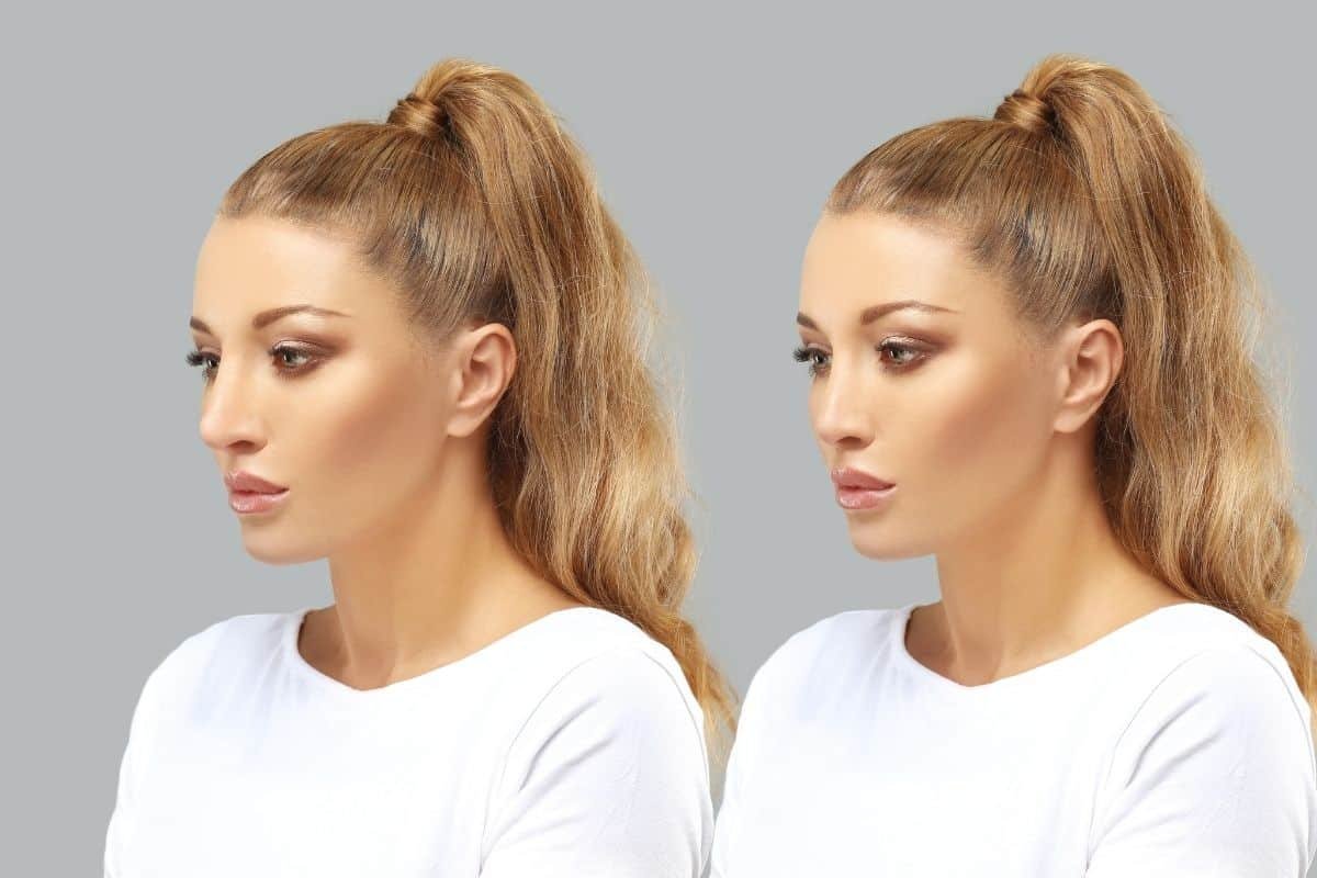 after rhinoplasty