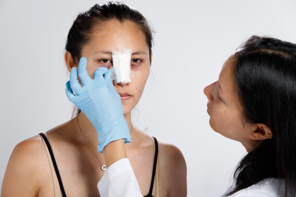 After Rhinoplasty Surgery 1 after rhinoplasty surgery recovery