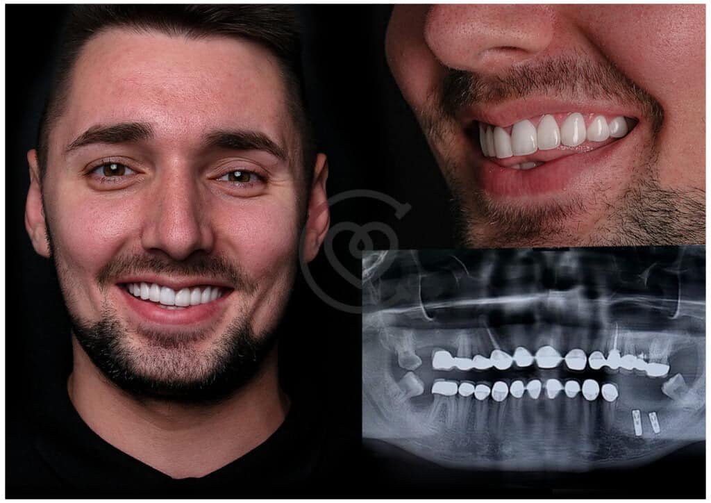 Dental Crowns Before and After with X-ray
