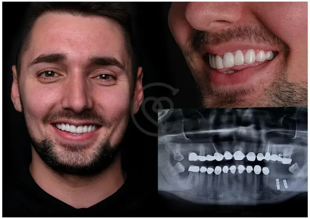 Dental Crowns - Detailed Guide 3 Dental Crowns Before and After with X-ray