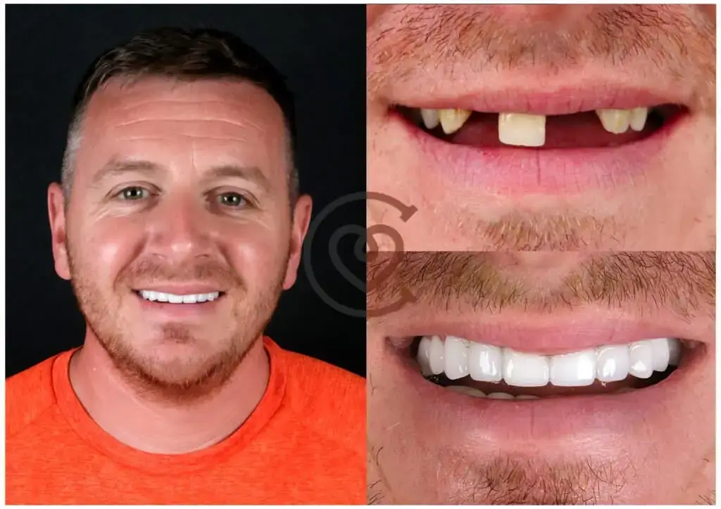 Dental Crowns - Detailed Guide 4 Dental Crowns Before and After