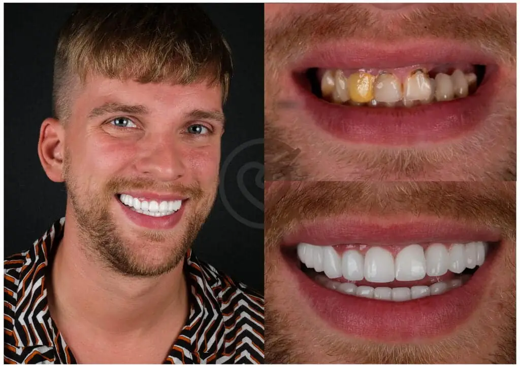 Hollywood Smile 1 Hollywood Smile Before After Photo