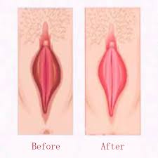 Blanchiment Vaginal 2 Schéma de blanchiment vaginal