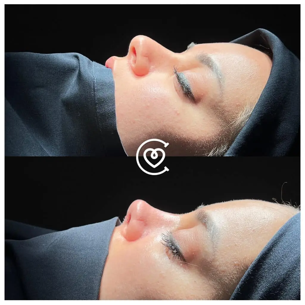 How to Choose Best Rhinoplasty Surgeon in Turkey 2 Revision rhinoplasty before and after photo