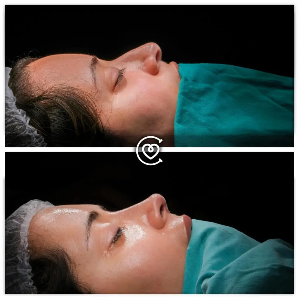 How to Choose Best Rhinoplasty Surgeon in Turkey 3 Rhinoplasty Surgery before and after photo