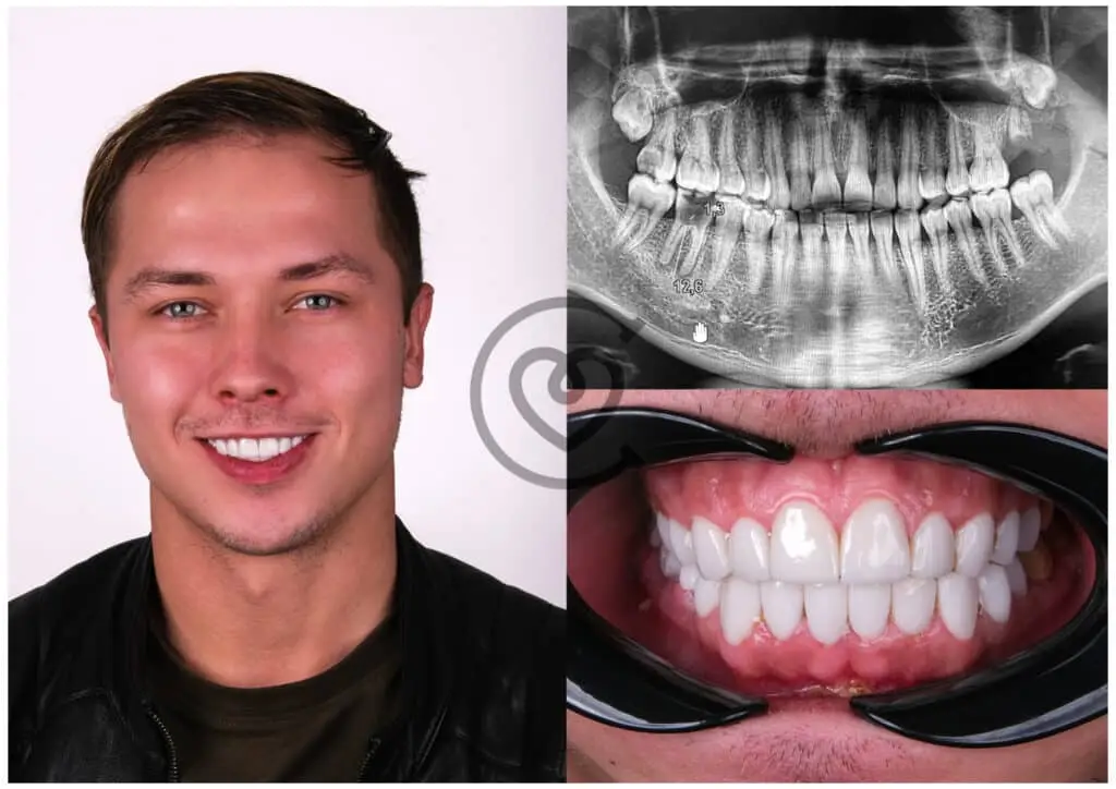 Dental Crowns - Detailed Guide 2 Dental Crowns Before and After with X-ray