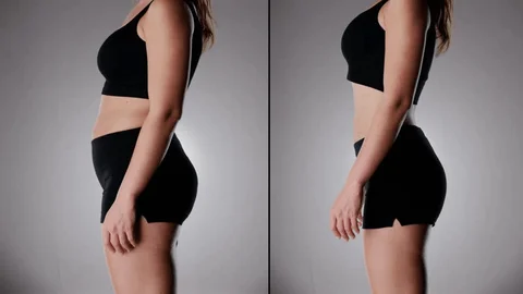 HD liposuction before & after