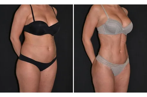 HD liposuction before and after