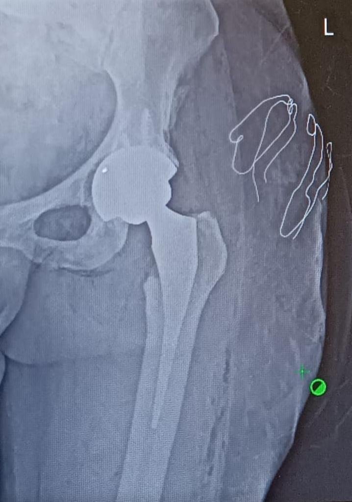Hip Replacement Surgery in Antalya: 5 Best Safe Benefits 2 hip replacement surgery