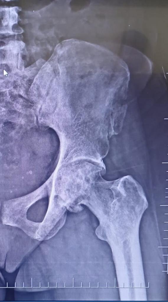 hip replacement surgery