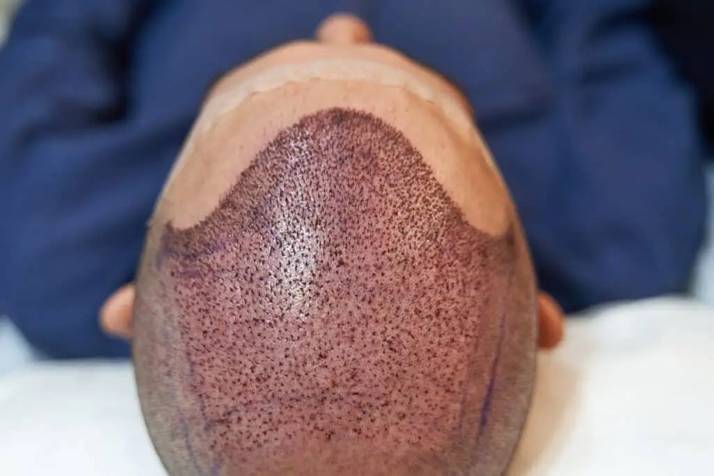 how to sleep hair transplant