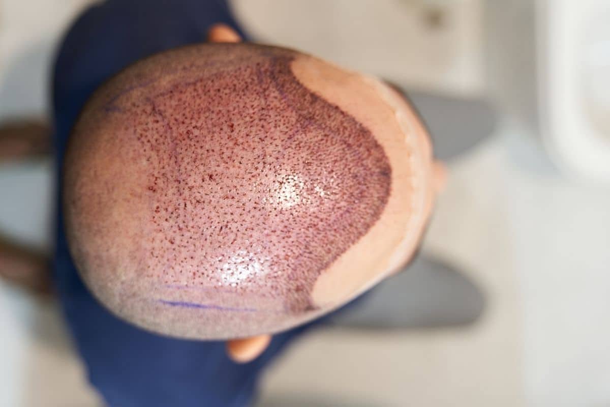 second hair transplant