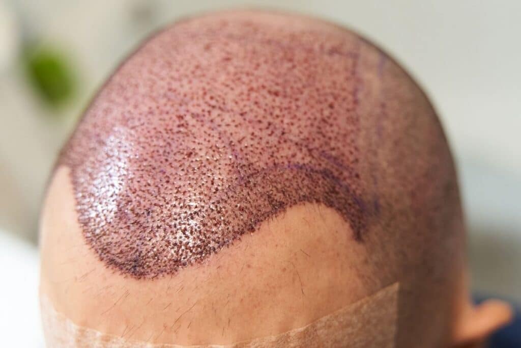 what is a body hair transplant