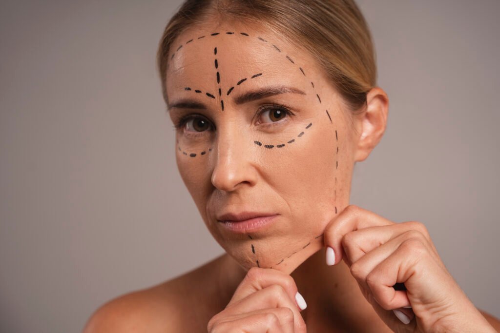Deep plane Face lift