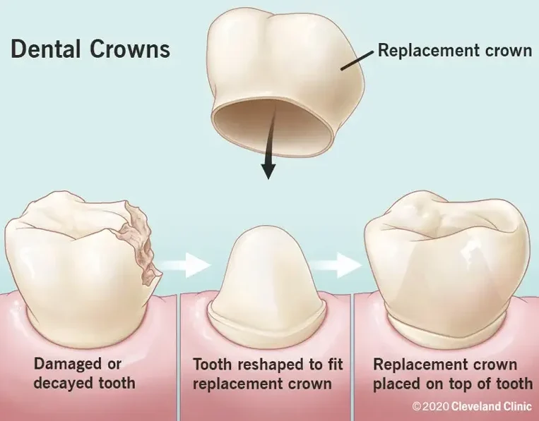 Dental Crowns - Detailed Guide 1 Dental crown diagram showing how dental crowns work.