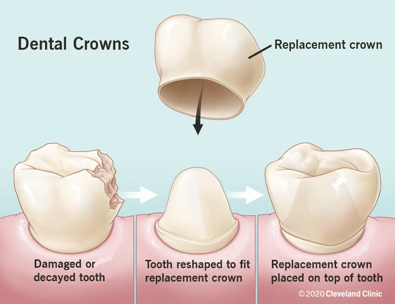 Dental crown diagram showing how dental crowns work.