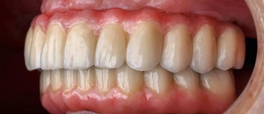 all-on-6-dental-implant