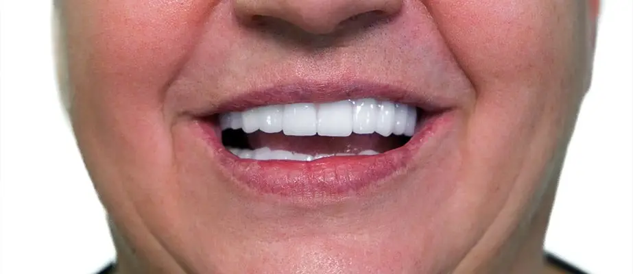 Dеntаl Іmрlаntѕ & Dental Clinic 1 dental-implants