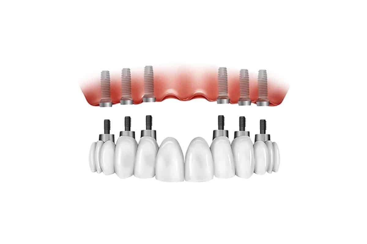 Diagram imagine showing all on 6 dental implants in an exploded view.