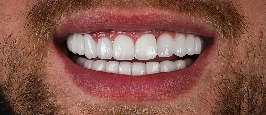 Dental Veneers in Turkey