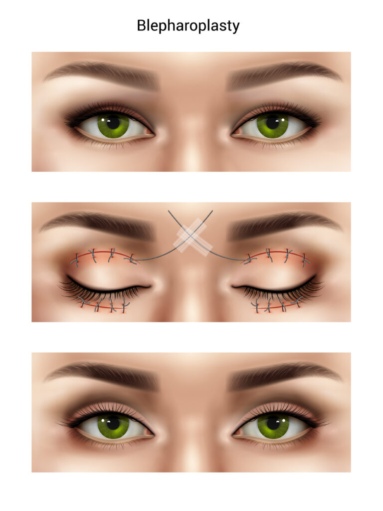 Upper Eyelid Surgery Blepharoplasty