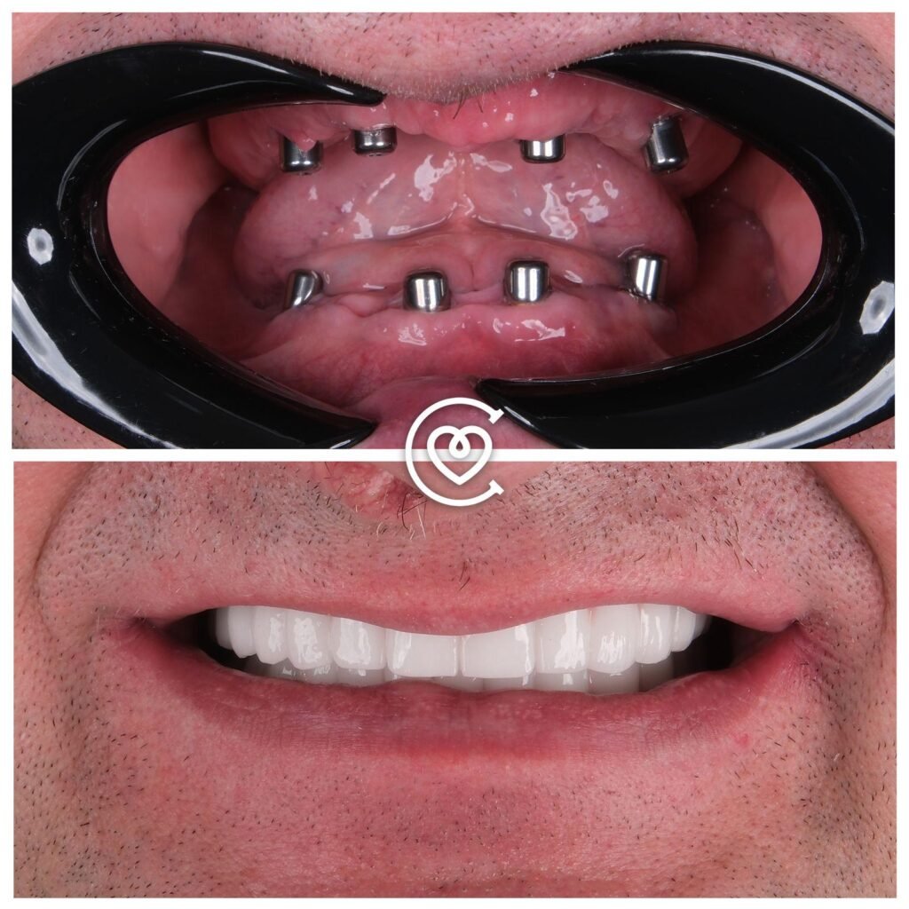 dental implants in Turkey
