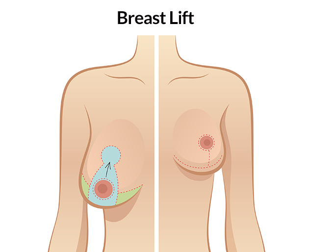 Breast Reduction Or Breast Lift In Turkey
