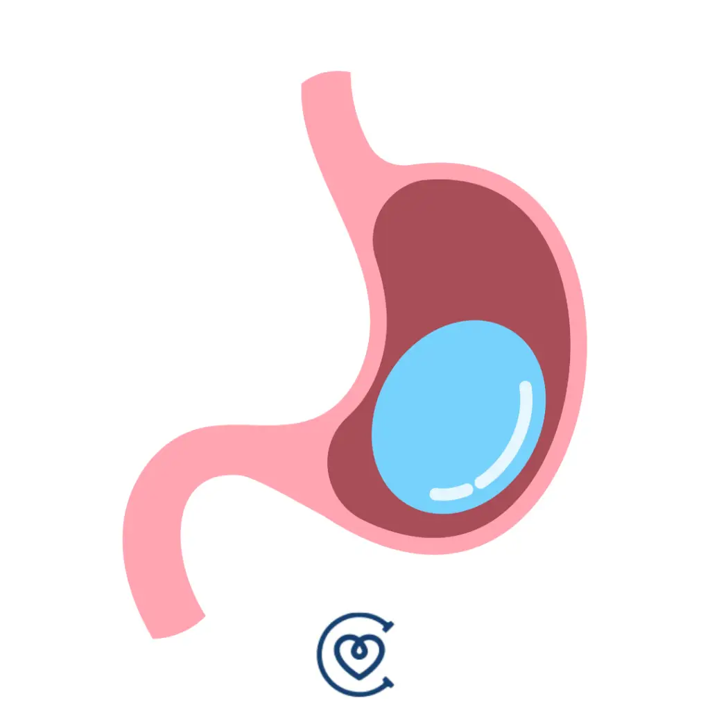 Gastric Balloon in Turkey