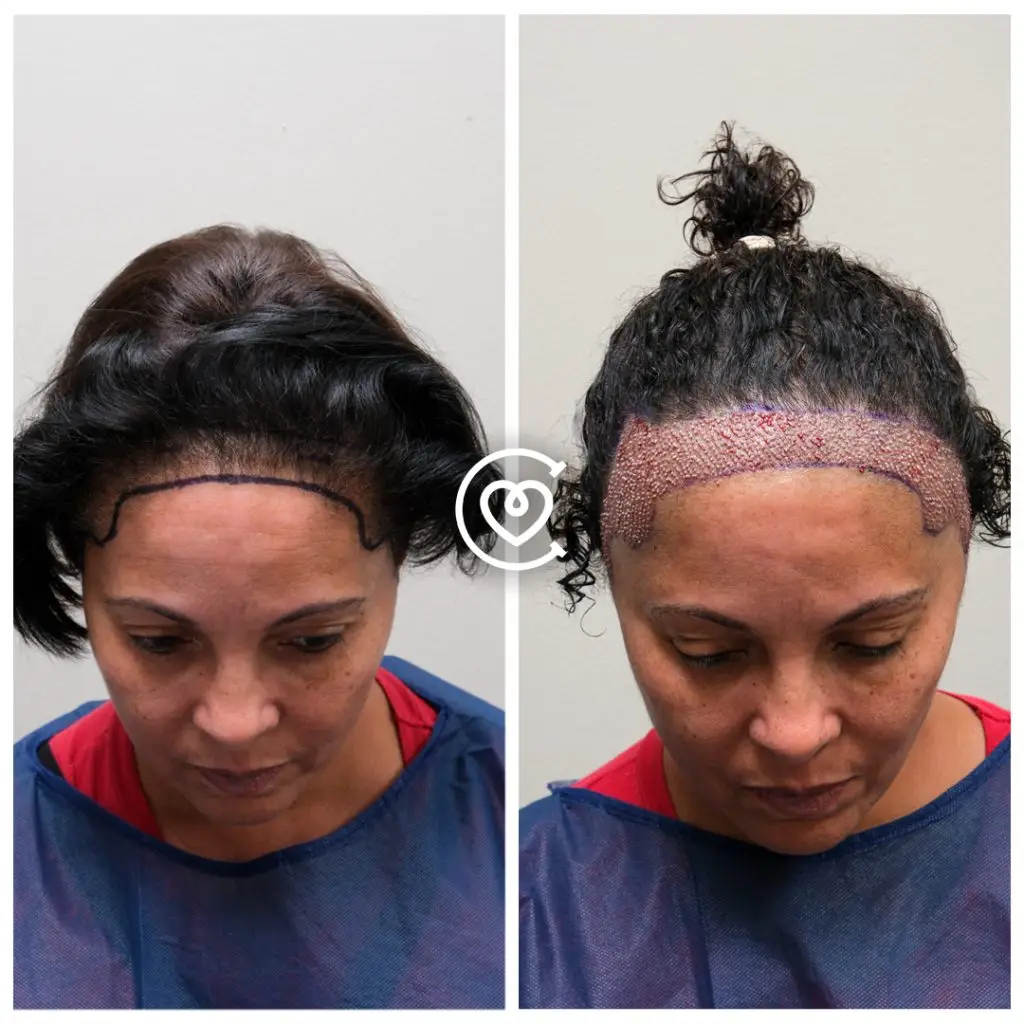 Hair Transplant for Women