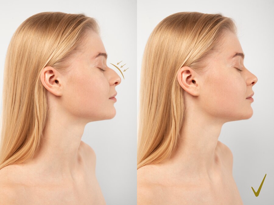 Rhinoplasty & Septorhinoplasty