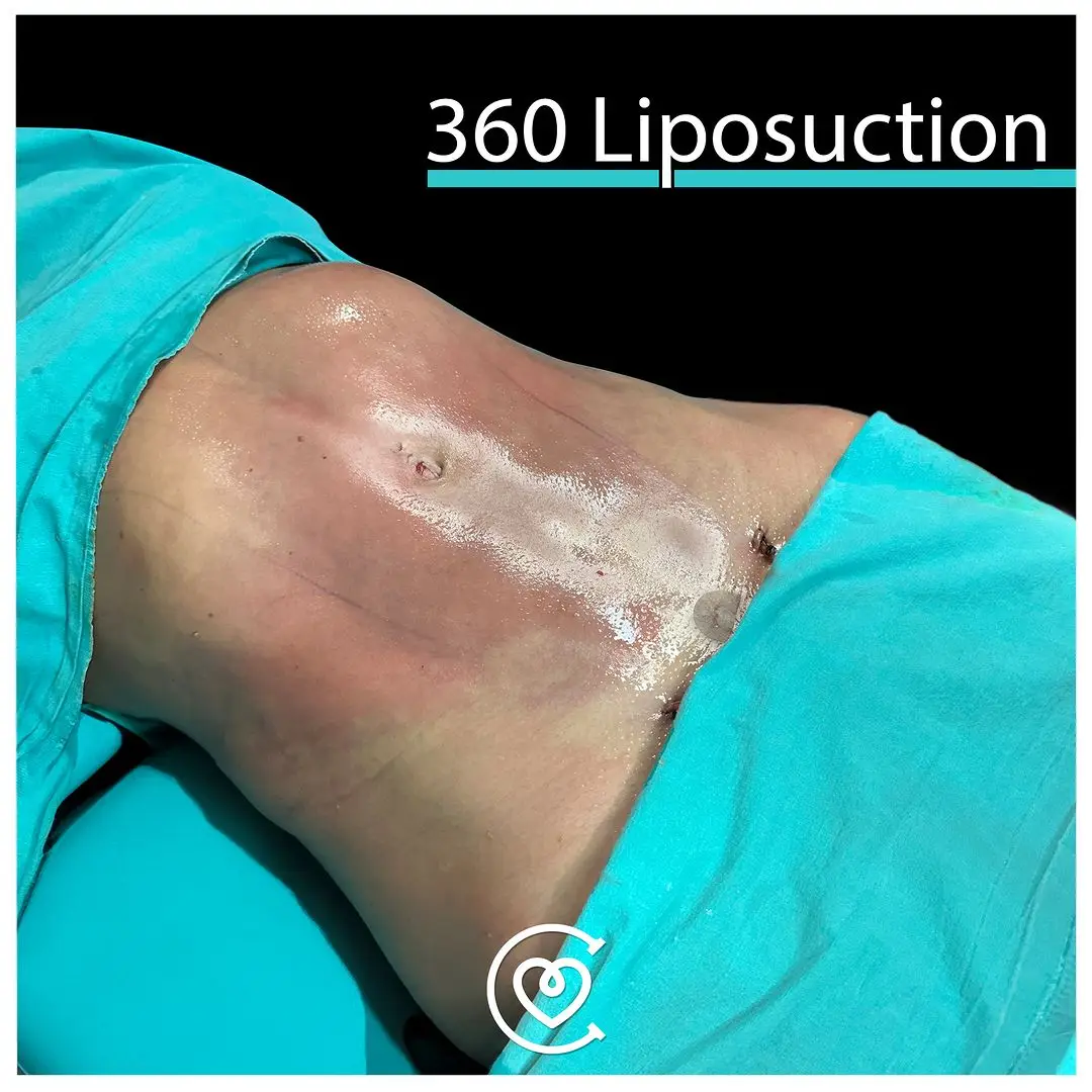 Liposuction Turkey | Remove Fat & Sculpt Your Body 4 Abdominal Etching and 360 Liposuction Photo