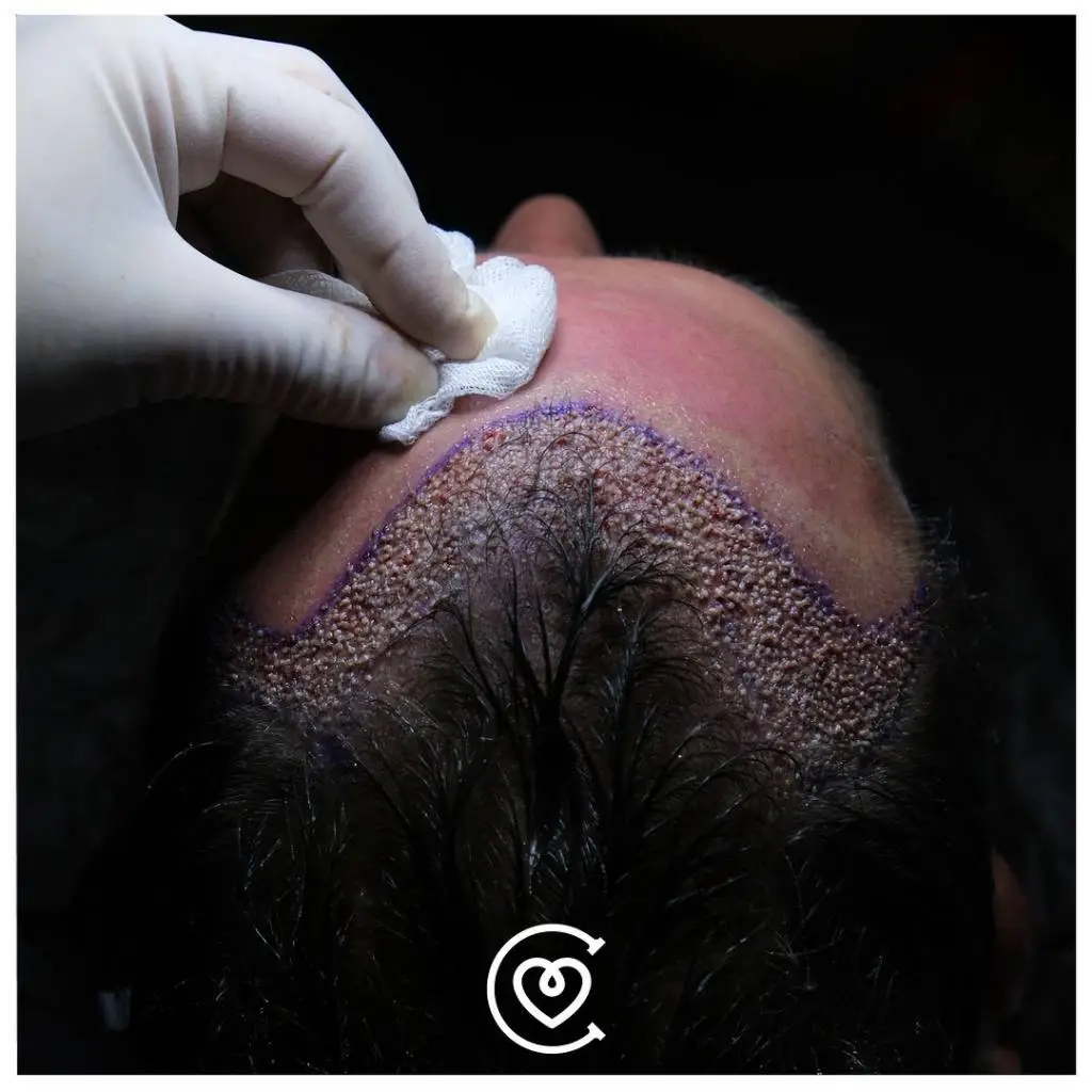 Hair Transplant in Turkey