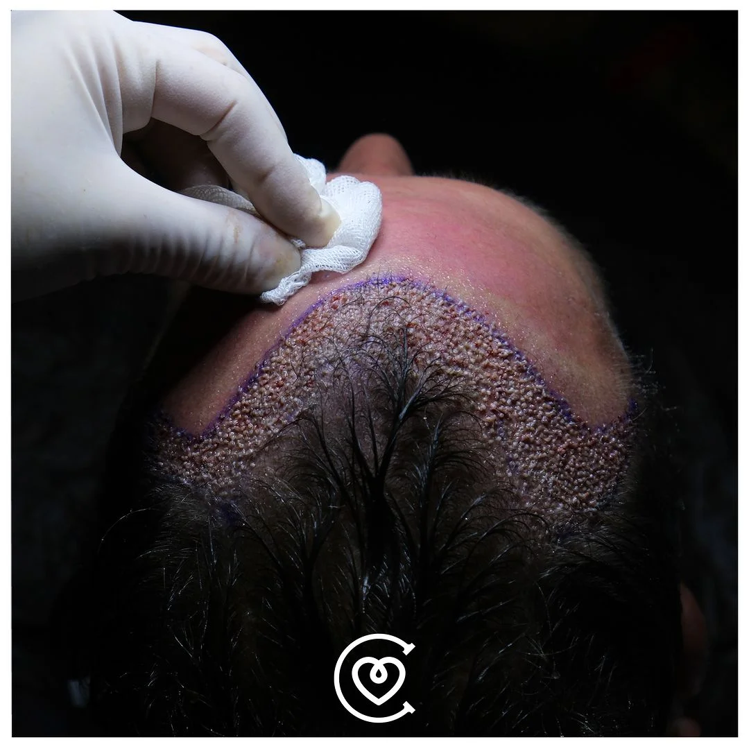 Hair Transplant in Turkey