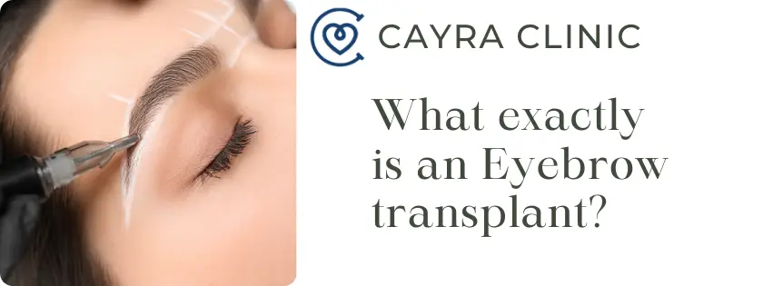 What exactly is an Eyebrow transplant