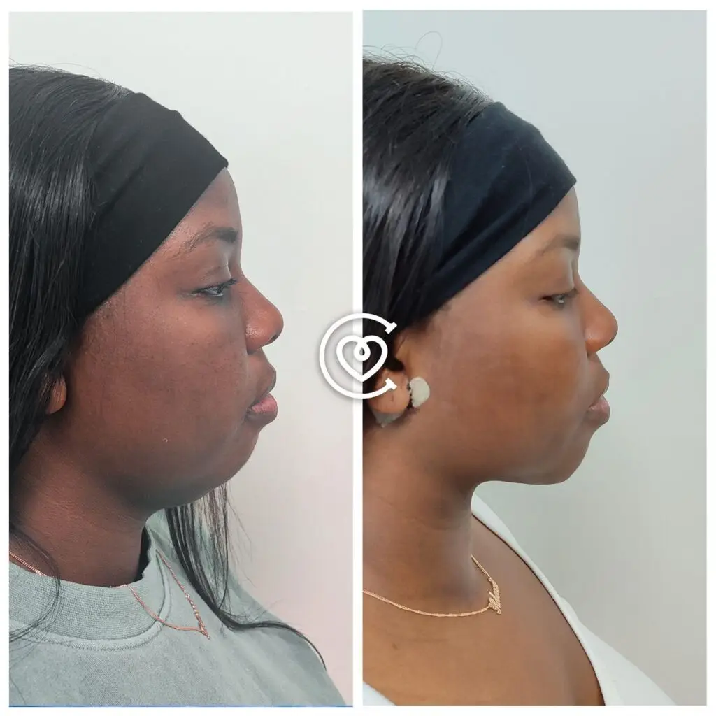 Buccal-fat-removal-before-after