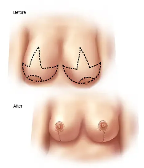 breast reduction and lift before and after e1749903081325