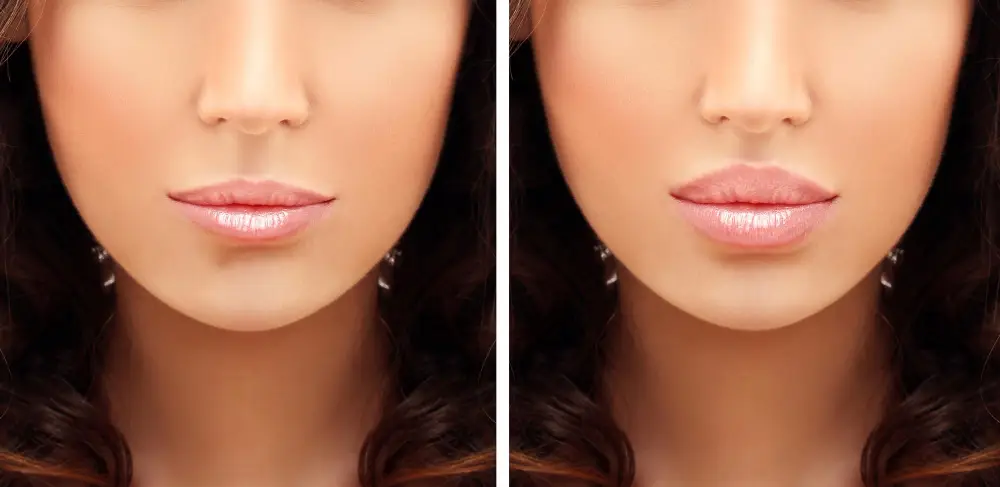 lip reduction before after