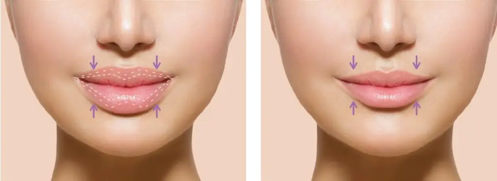 Lip reduction surgery