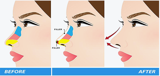 non-surgical Rhinoplasty