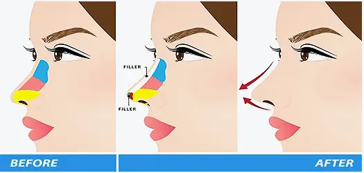 Non-Surgical Rhinoplasty 2 non-surgical Rhinoplasty