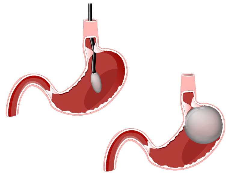 Gastric Balloon