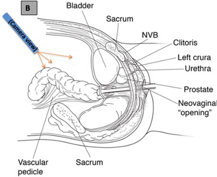 Colon Vaginoplasty