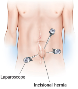 Hernia Surgery