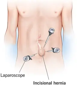 Hernia Surgery