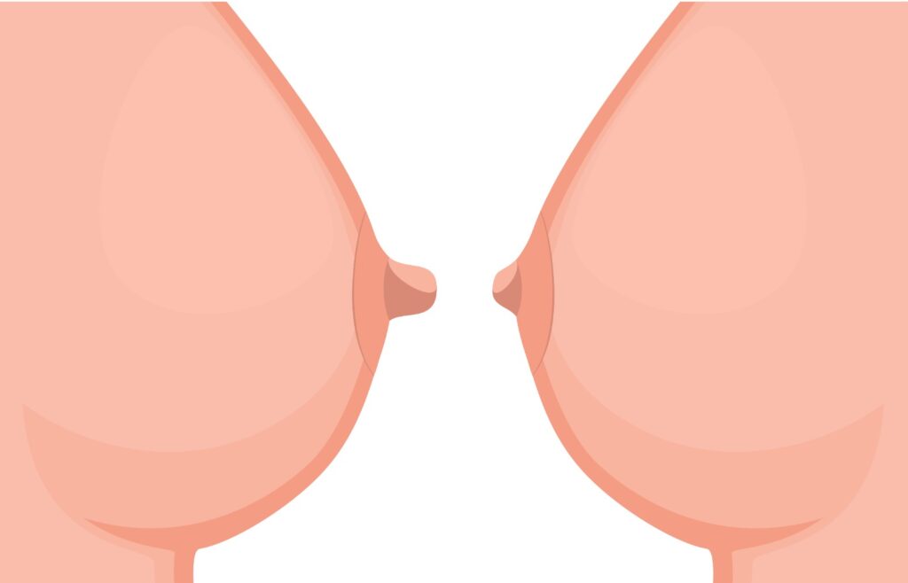 Nipple Reduction Surgery 1 Nipple Reduction Surgery