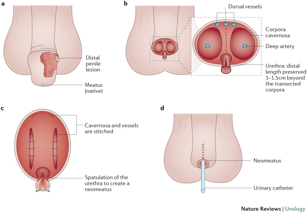 Penile Preserving Vaginoplasty