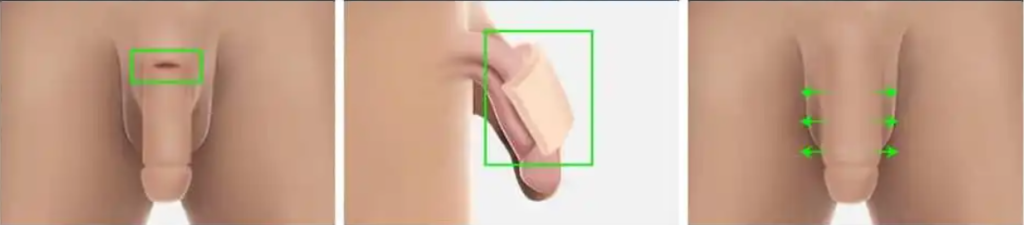 Surgical Penis Enlargement Penis Enlargement