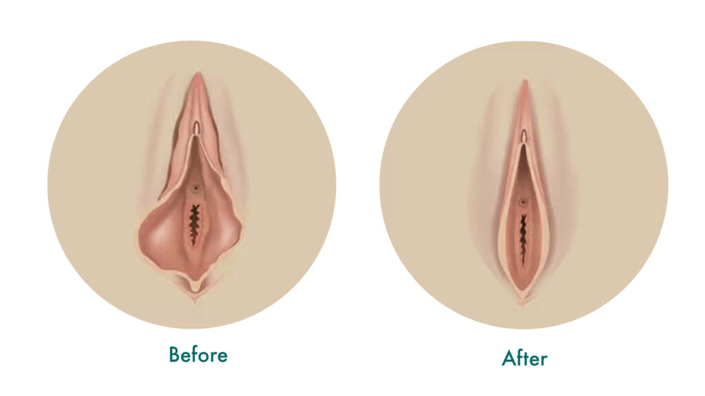 Vaginal Tightening Vaginoplasty